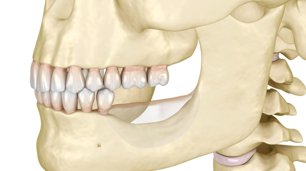 Bone Loss Restoration Techniques for Dental Implants