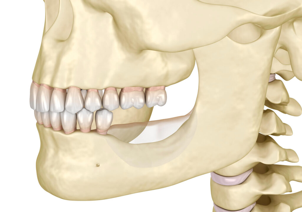 Bone Loss Restoration Techniques for Dental Implants