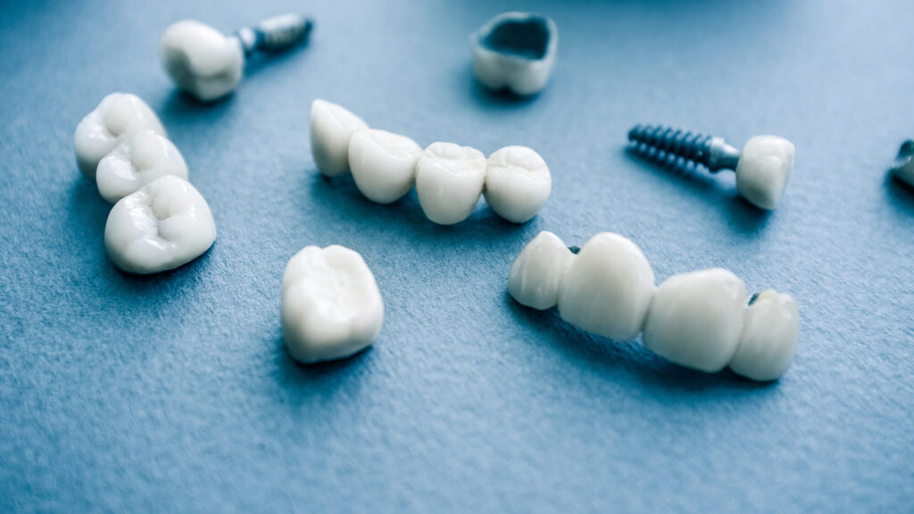 Mini Dental Implants vs Standard Implants