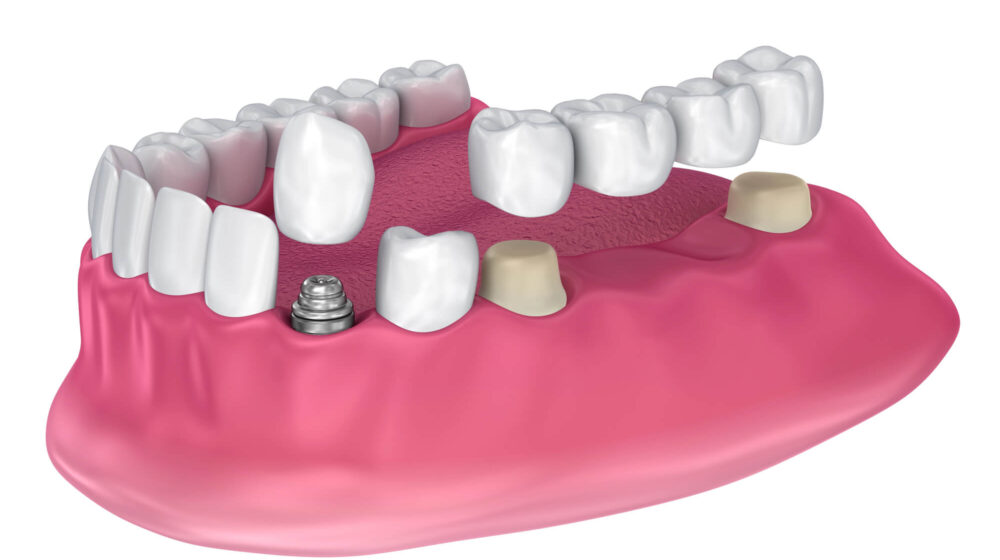 What Makes Implant-Supported Dentures Unique
