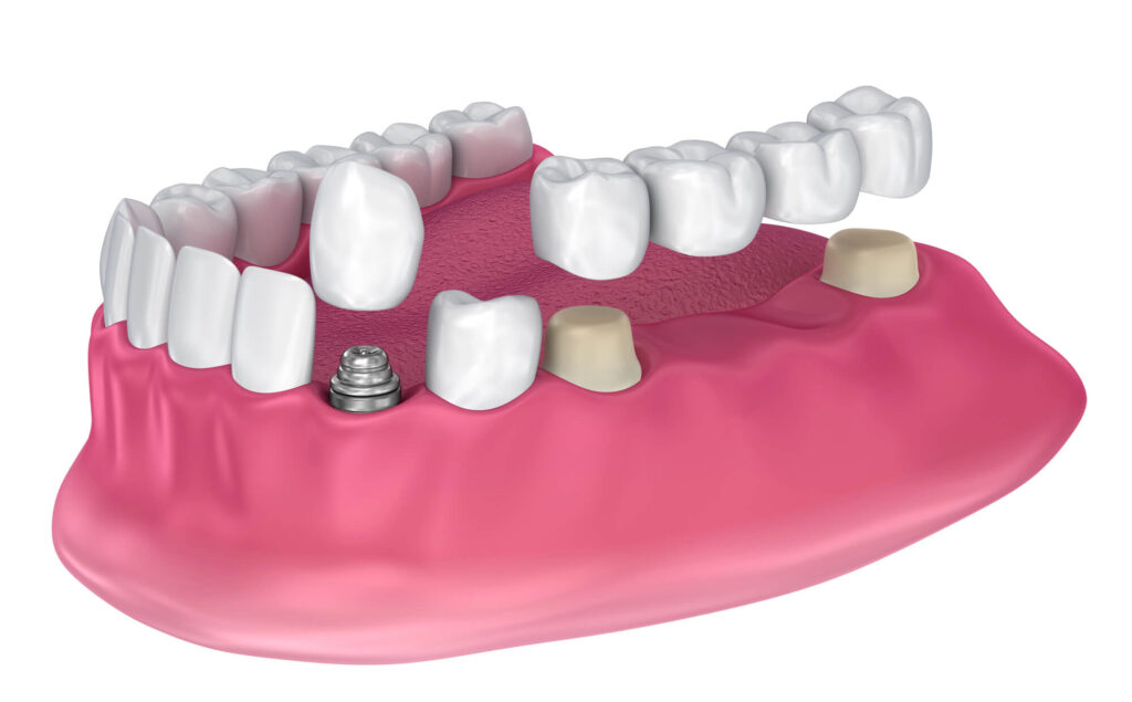 What Makes Implant-Supported Dentures Unique
