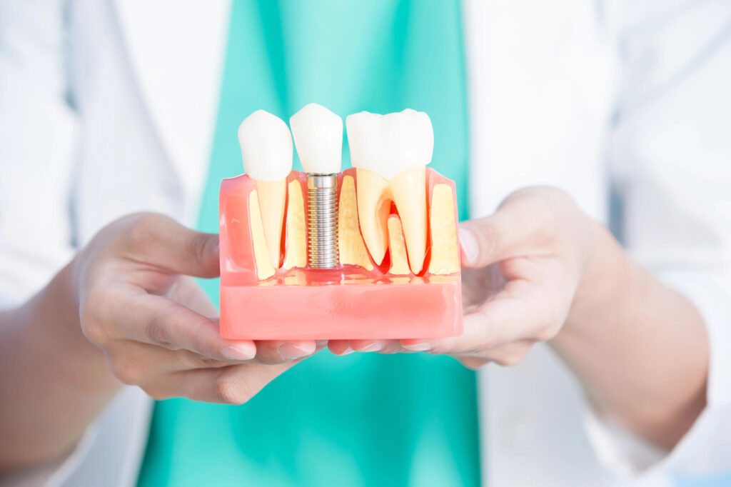 Comprehensive Guide to Dental Implant Costs