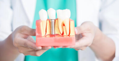 Comprehensive Guide to Dental Implant Costs