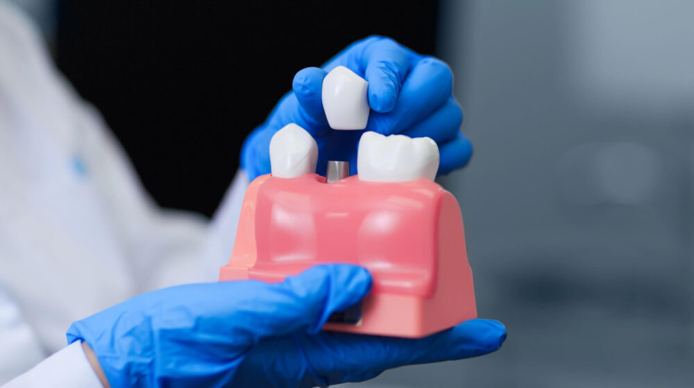 Benefits of Dental Implants Over Traditional Alternatives