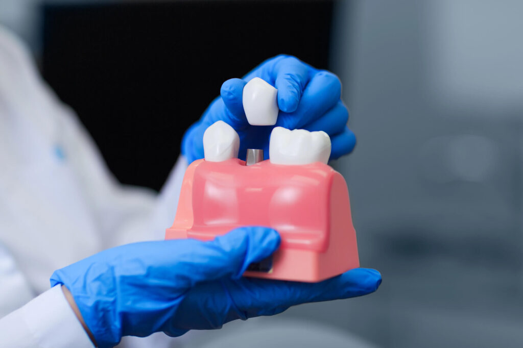 Benefits of Dental Implants Over Traditional Alternatives
