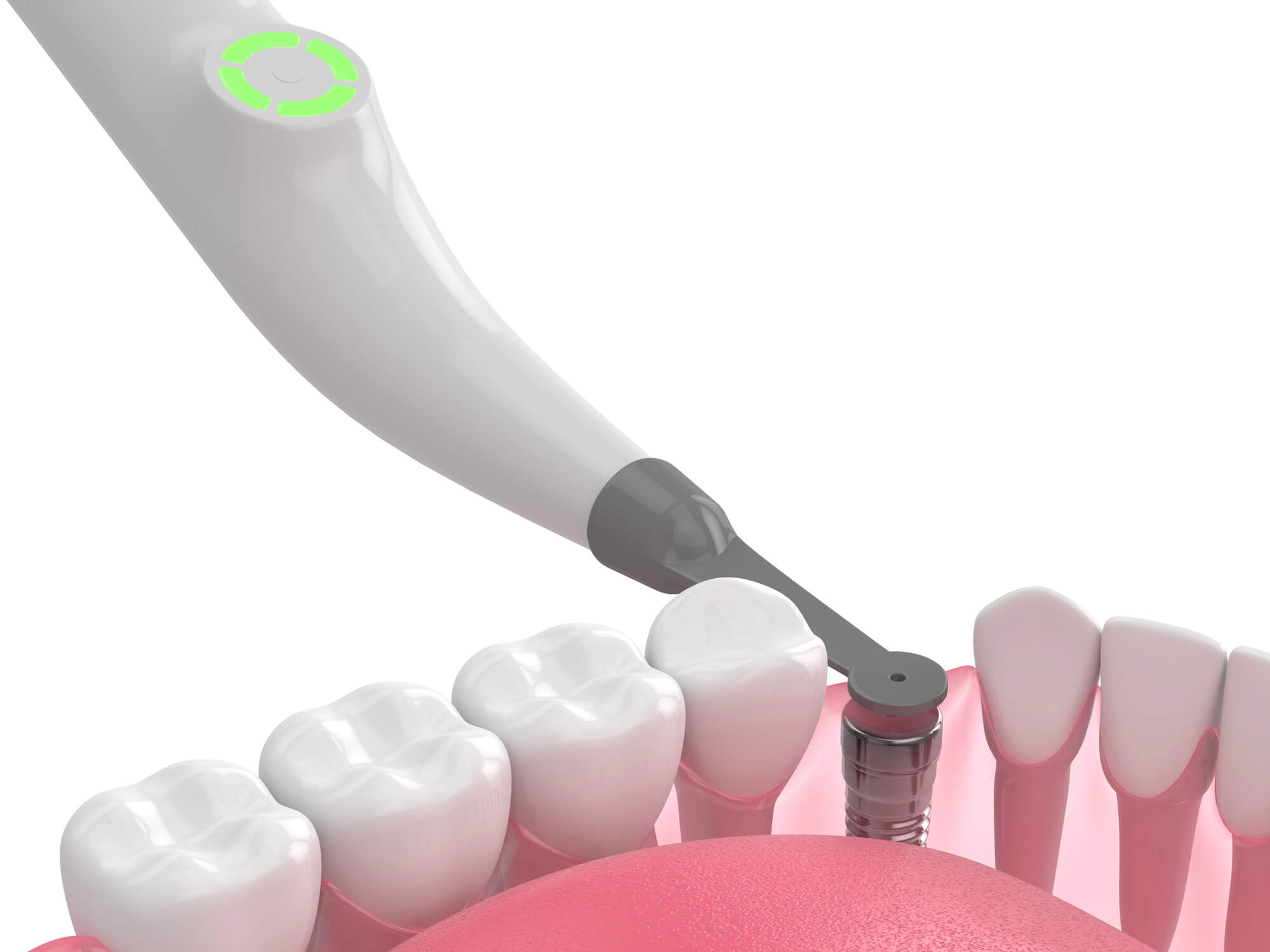 Comparing Flapless Versus Flapped Dental Implant Surgery