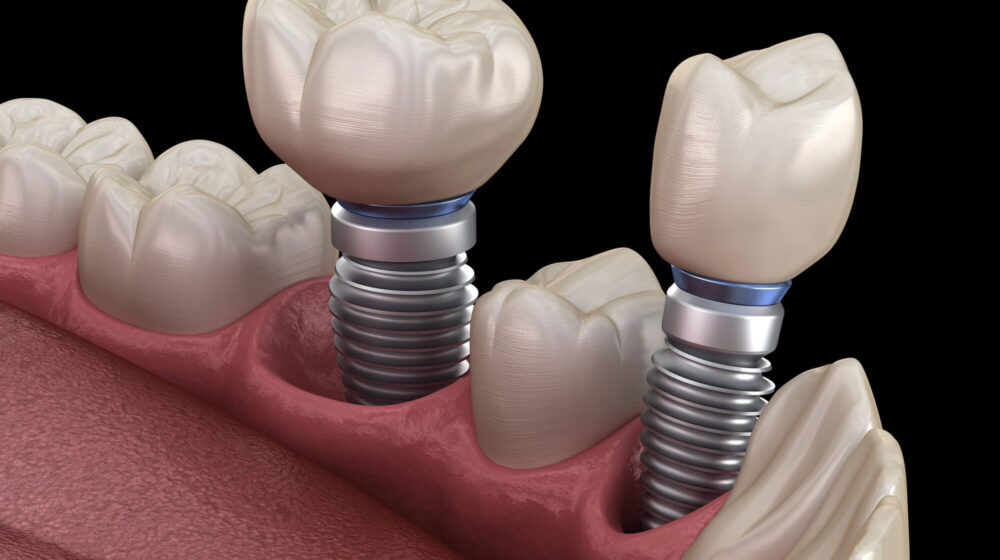Comparing Flapless Versus Flapped Dental Implant Surgery