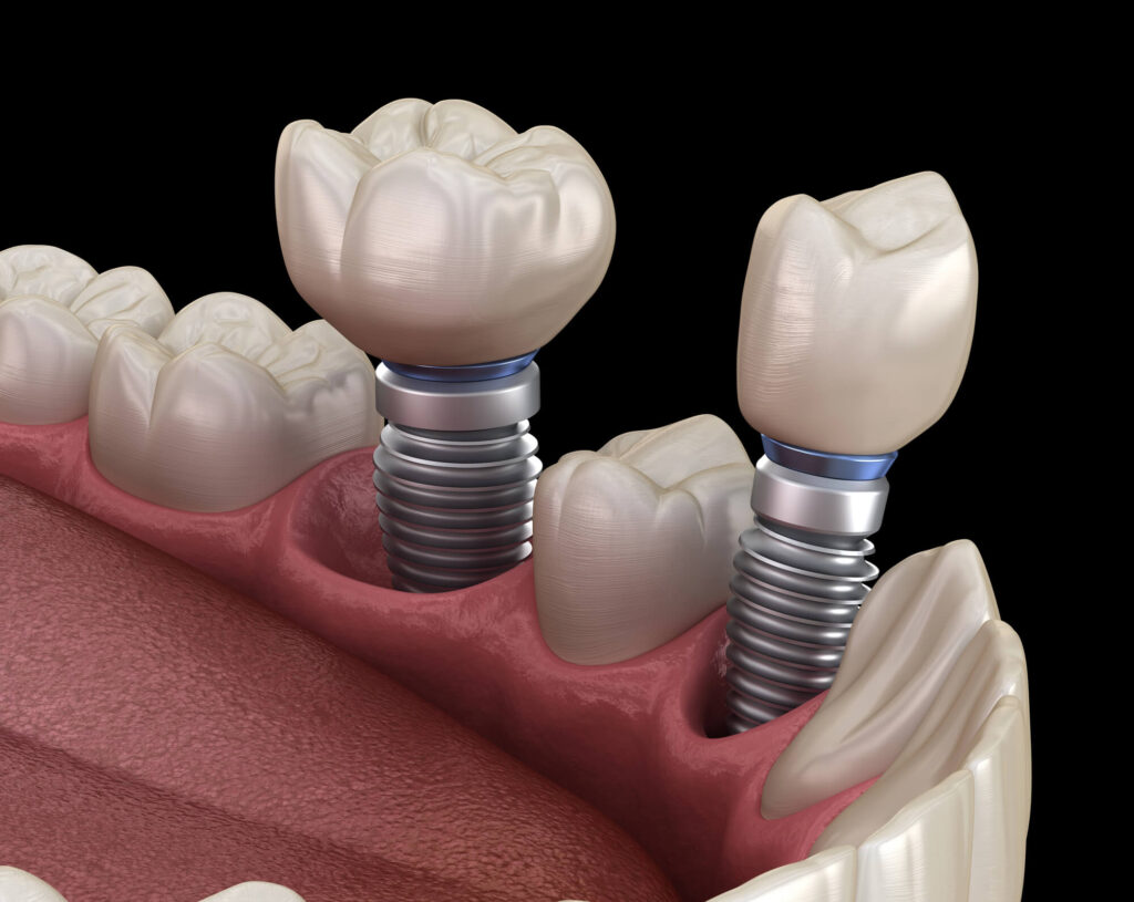 Comparing Flapless Versus Flapped Dental Implant Surgery