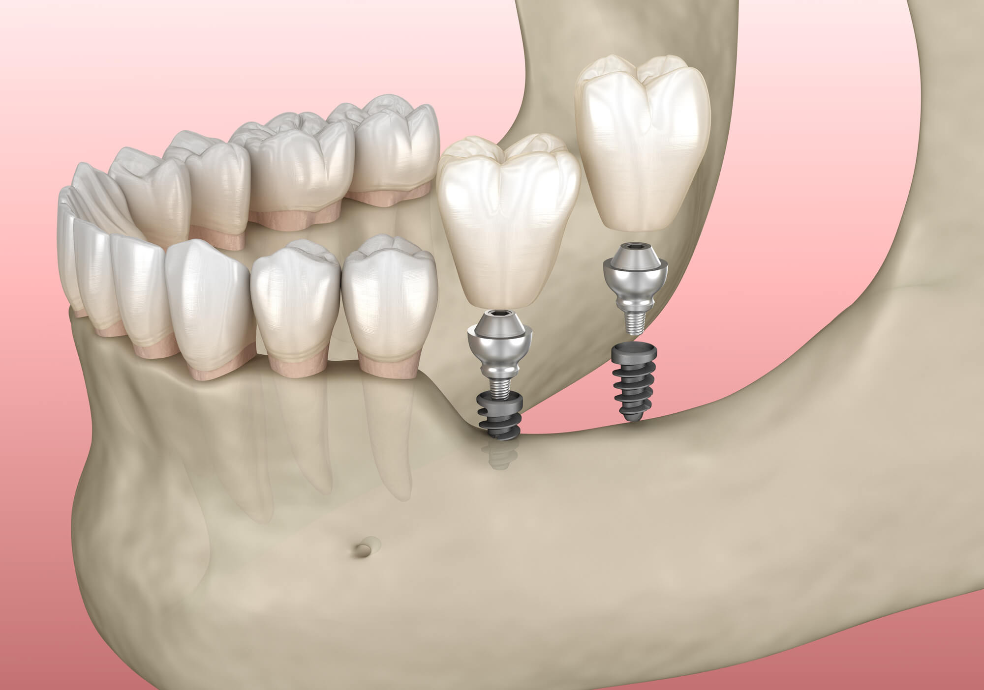 Comparing Flapless Versus Flapped Dental Implant Surgery