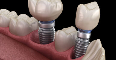Comparing Flapless Versus Flapped Dental Implant Surgery