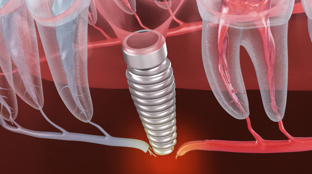 How to Spot Early Signs of Dental Implant Failure