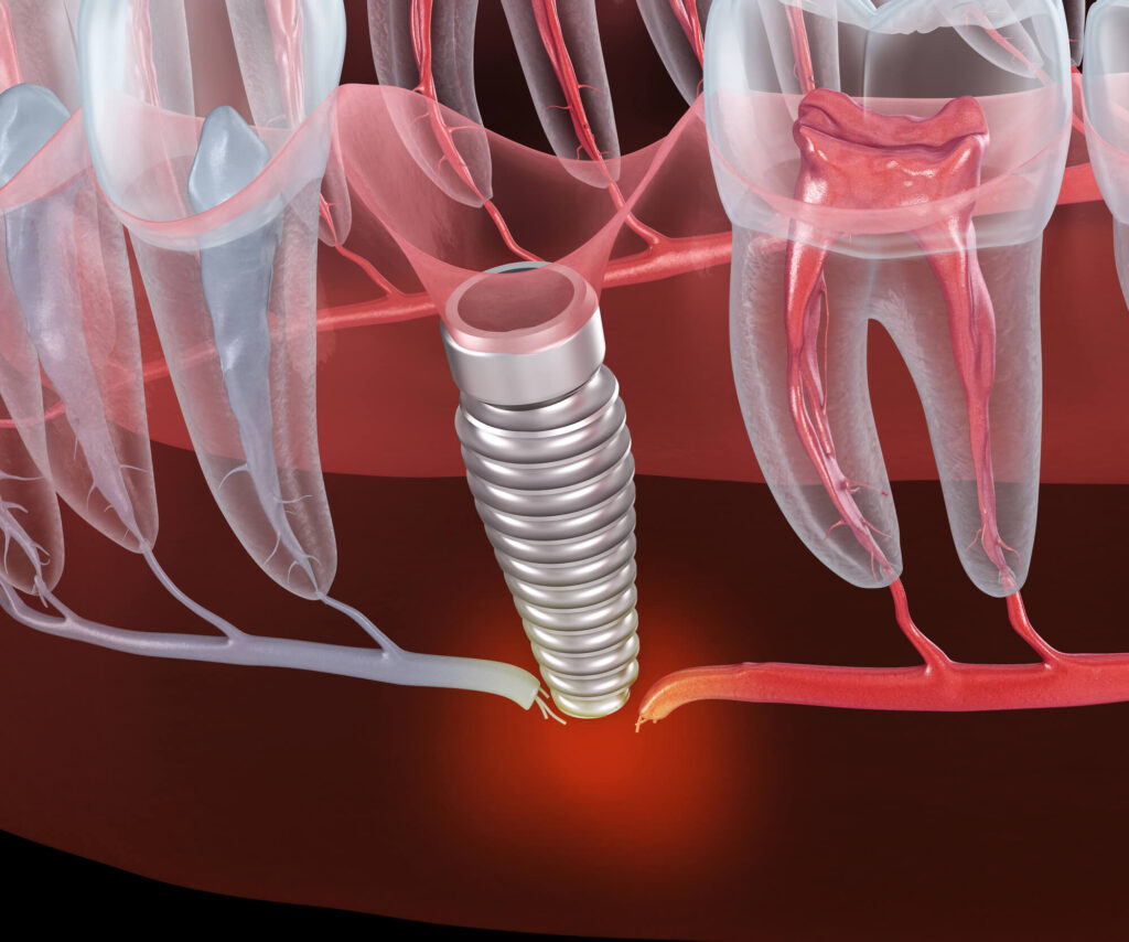 How to Spot Early Signs of Dental Implant Failure