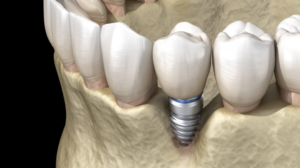 Minimally Invasive Options for Implant Revision