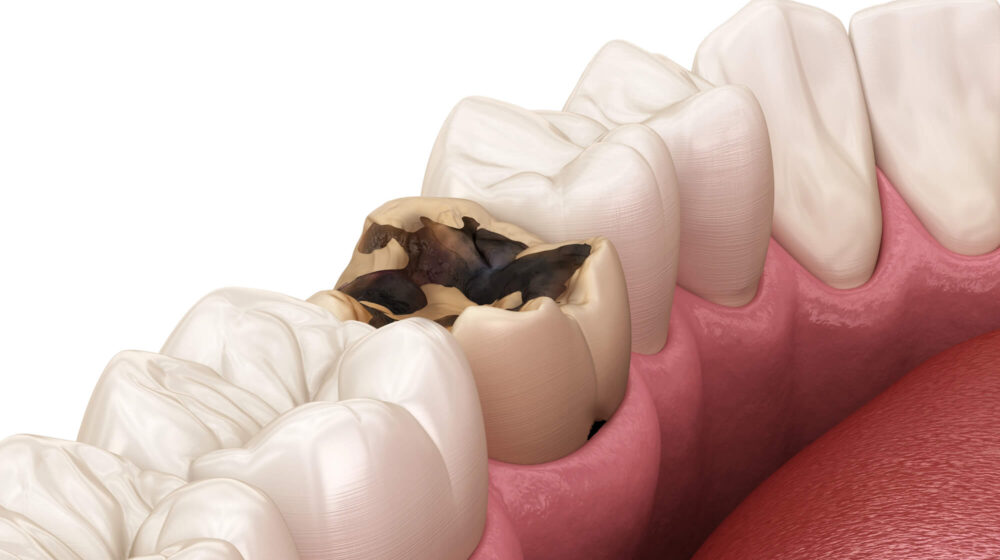 Temporary Crowns A Bridge to Your Permanent Smile