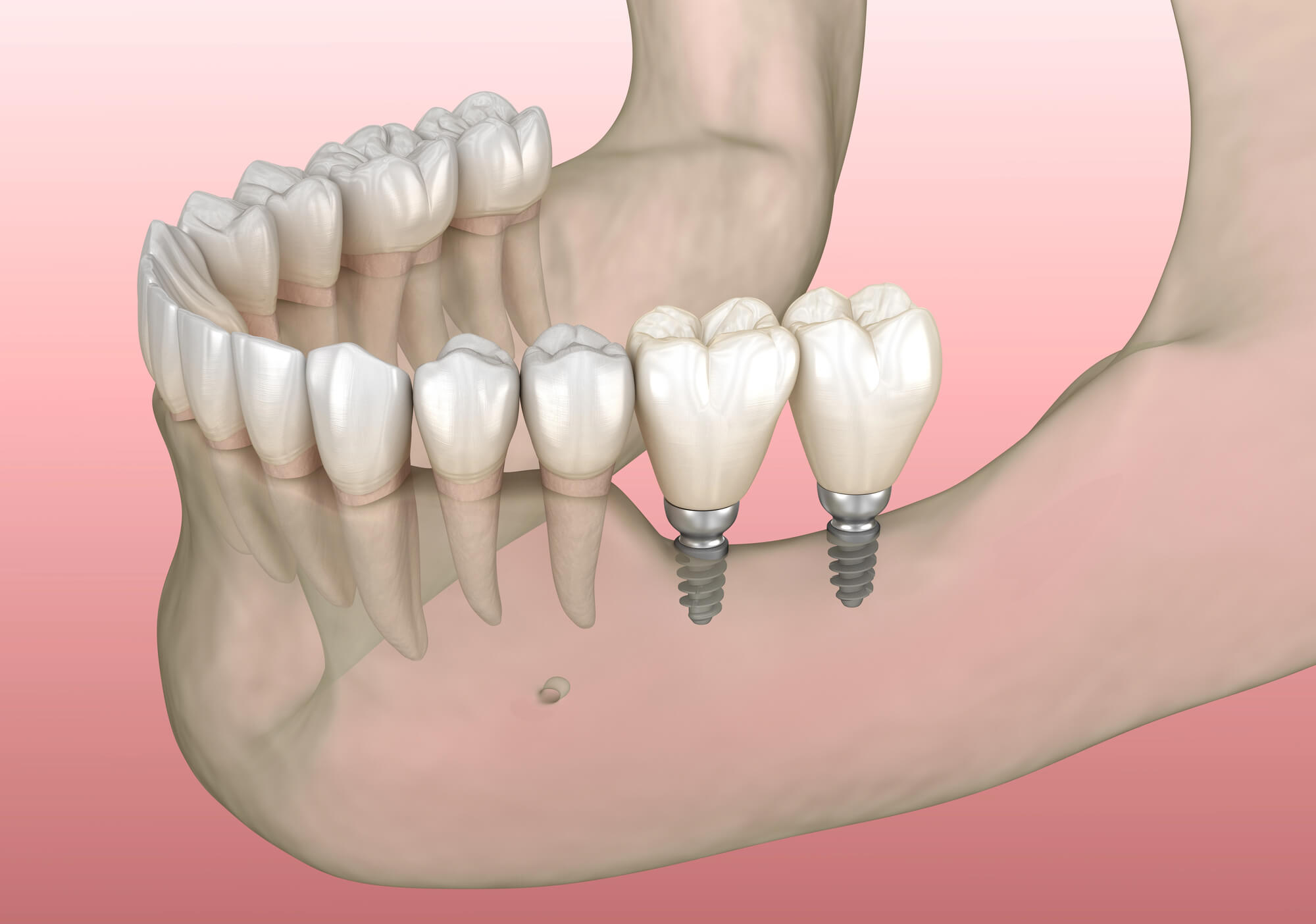 Dental Implants in Treating Tooth Loss from Oral Cancer