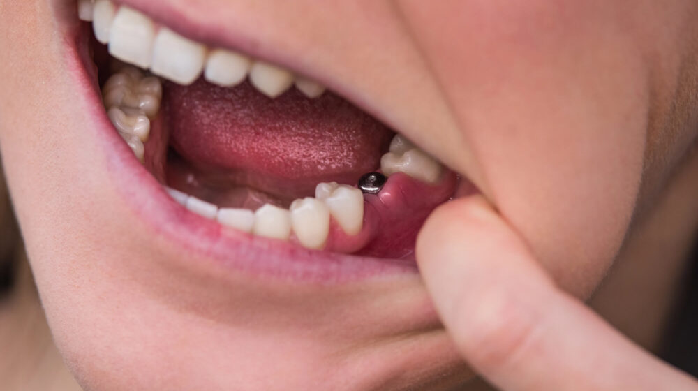 Dental Implants in Treating Tooth Loss from Oral Cancer