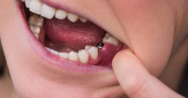 Dental Implants in Treating Tooth Loss from Oral Cancer