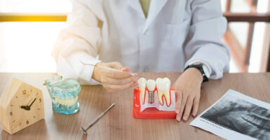 Durability of Titanium Dental Implants