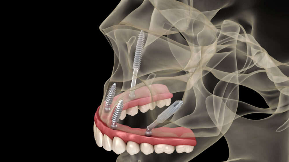 Understanding Zygomatic Implants for Severe Bone Loss