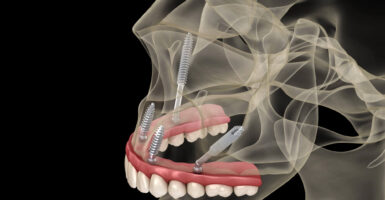 Understanding Zygomatic Implants for Severe Bone Loss