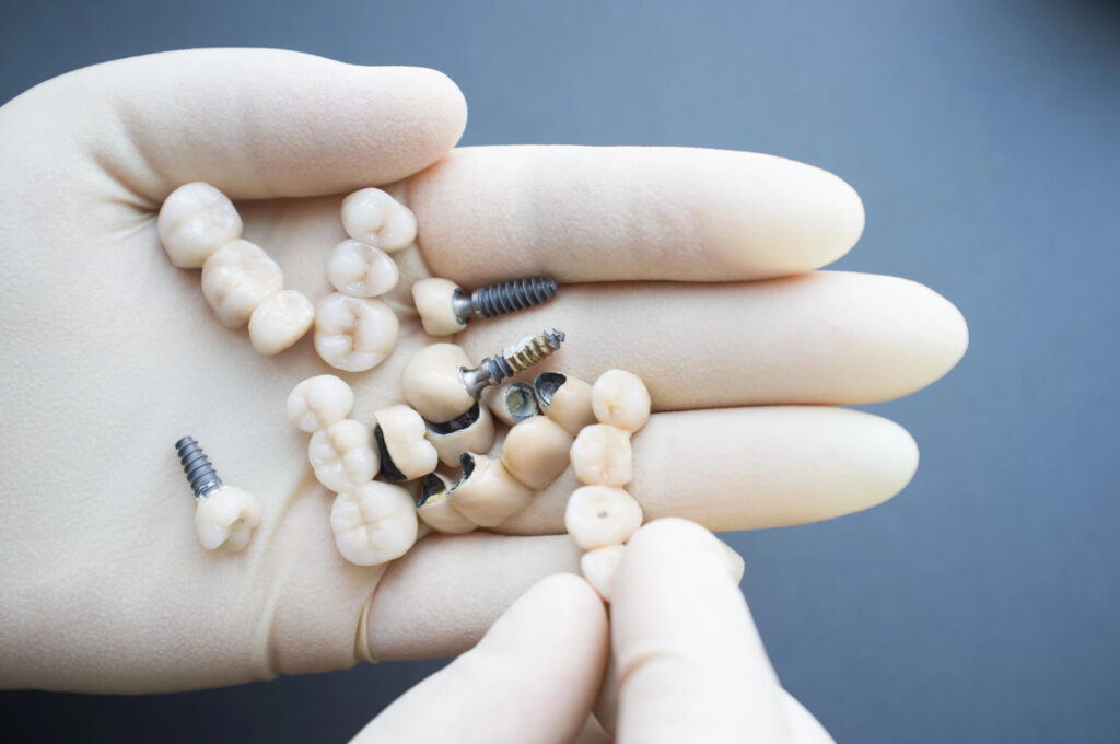 Misconceptions About Dental Implants A Guide for Patients