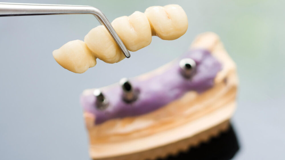 Implant-Supported Bridges: A Durable Alternative to Dentures