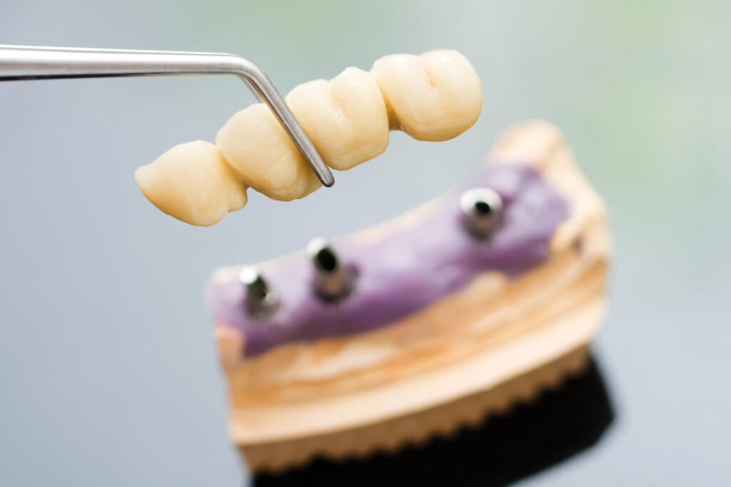 Implant-Supported Bridges: A Durable Alternative to Dentures