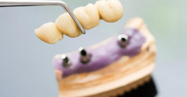 Implant-Supported Bridges: A Durable Alternative to Dentures