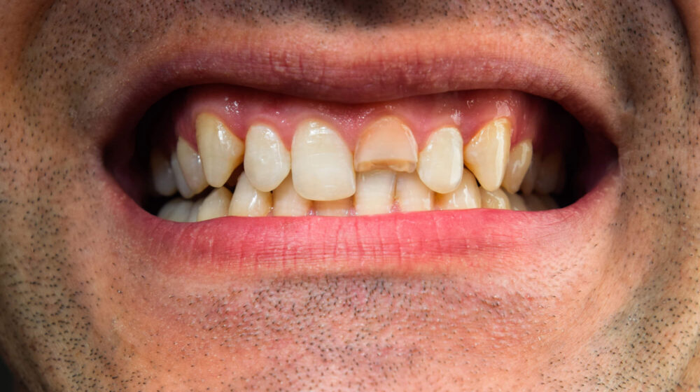 What Causes a Bad Smile Stains, Gaps, Crooked Teeth & Damage