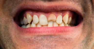 What Causes a Bad Smile Stains, Gaps, Crooked Teeth & Damage