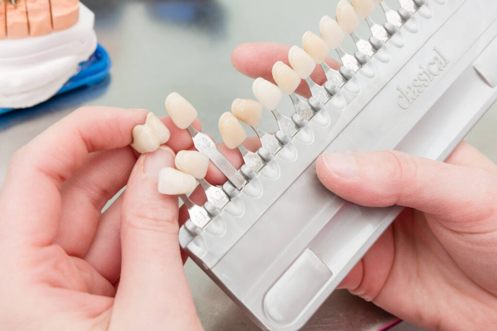 Veneers vs Crowns