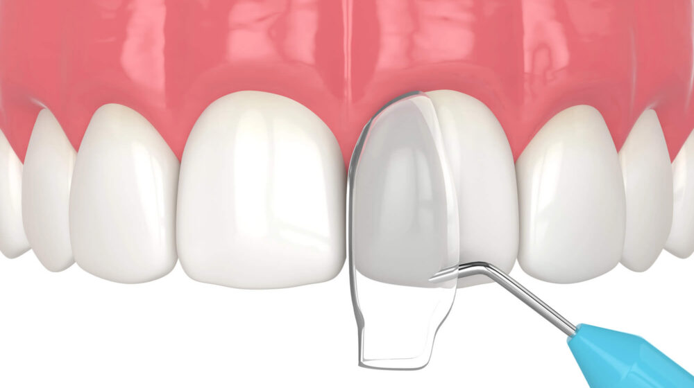 What is Cosmetic Tooth Bonding & What to Expect
