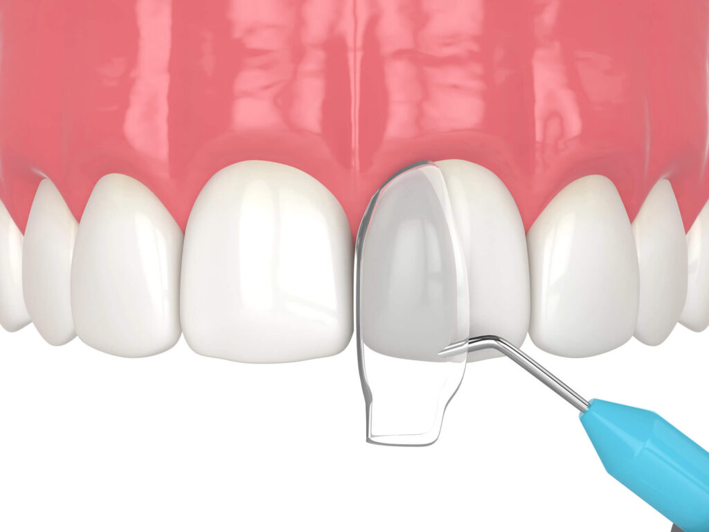 ¿Qué es el empaste dental cosmético y qué se puede esperar?