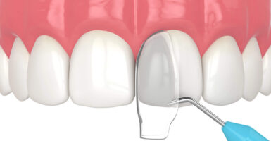 What is Cosmetic Tooth Bonding & What to Expect