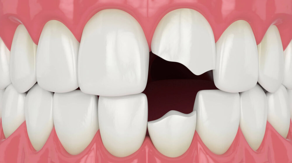 Chipped Tooth Repair