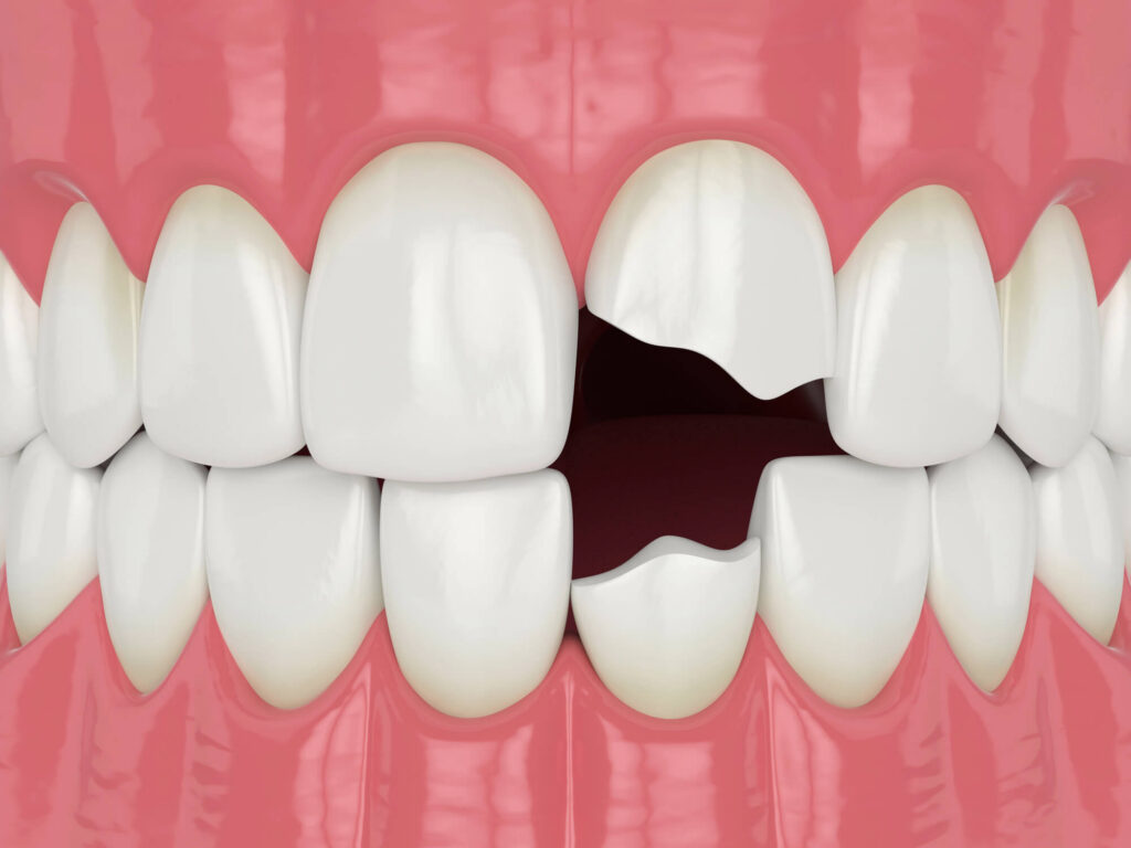 Chipped Tooth Repair
