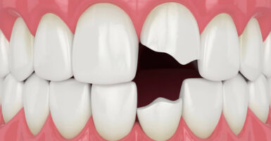 Chipped Tooth Repair