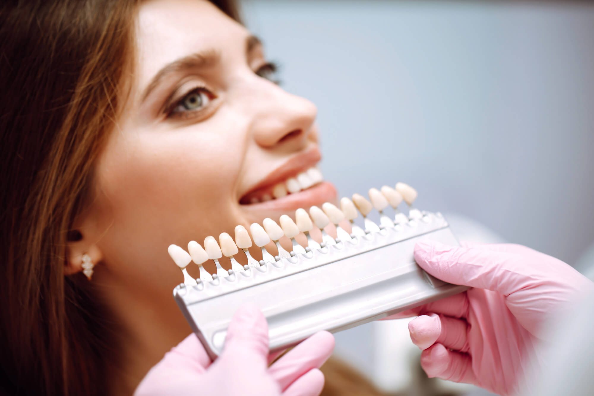 Composite Veneers