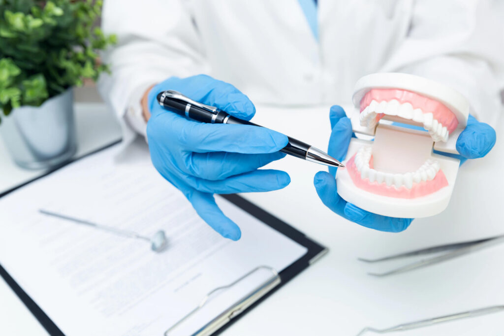 Composite Veneers