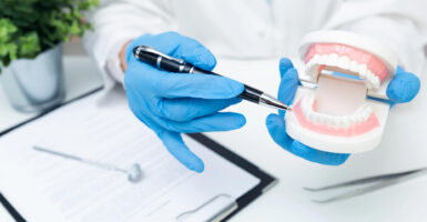 Composite Veneers
