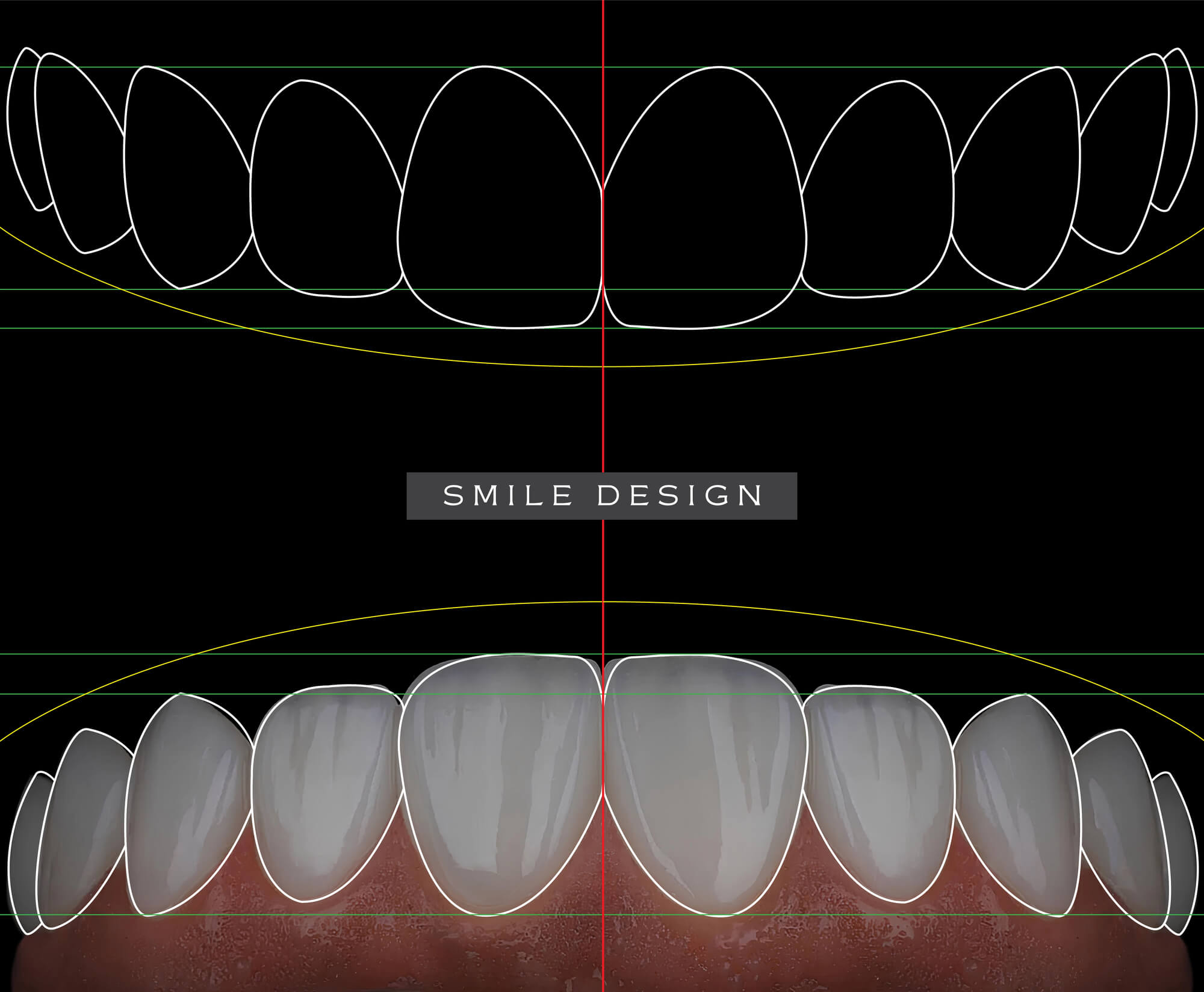 How Much Do Veneers Cost