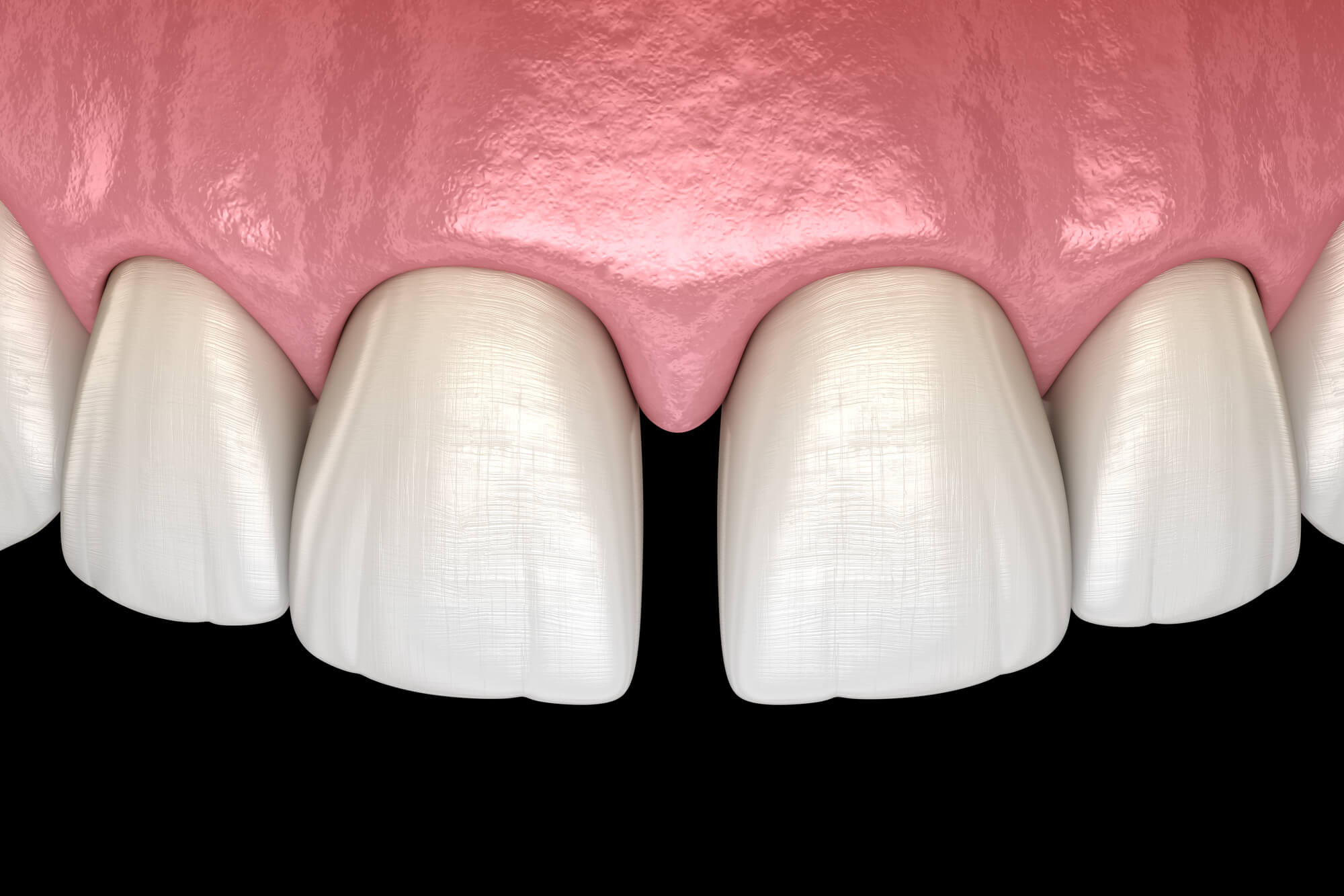 How to Fix Gap Teeth