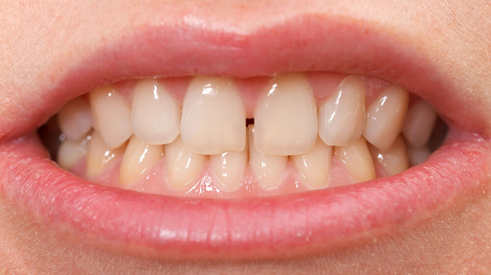 How to Fix Gap Teeth