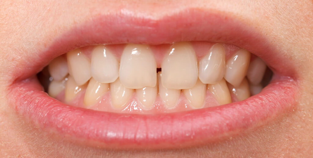 How to Fix Gap Teeth