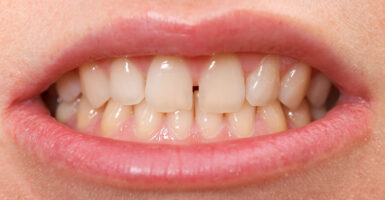 How to Fix Gap Teeth