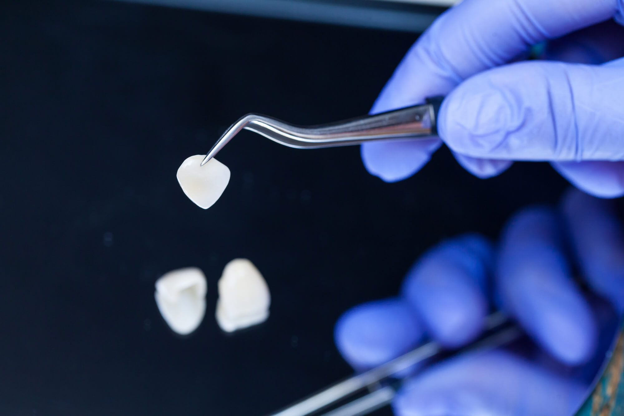 Same-Day Veneers and How CEREC Restorations Work