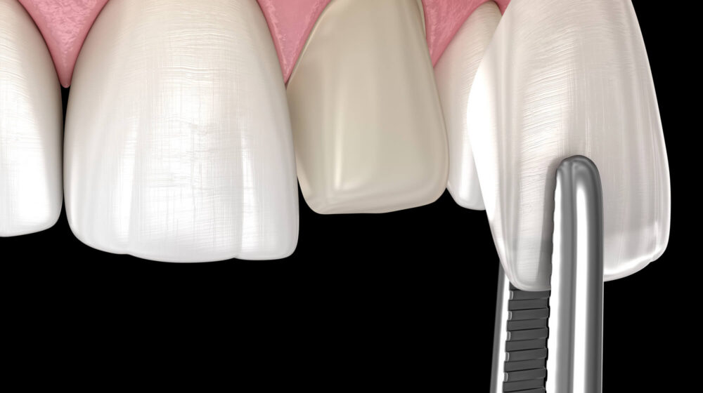 Same-Day Veneers and How CEREC Restorations Work
