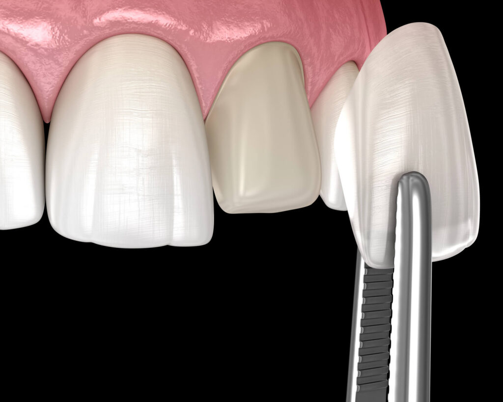 Same-Day Veneers and How CEREC Restorations Work