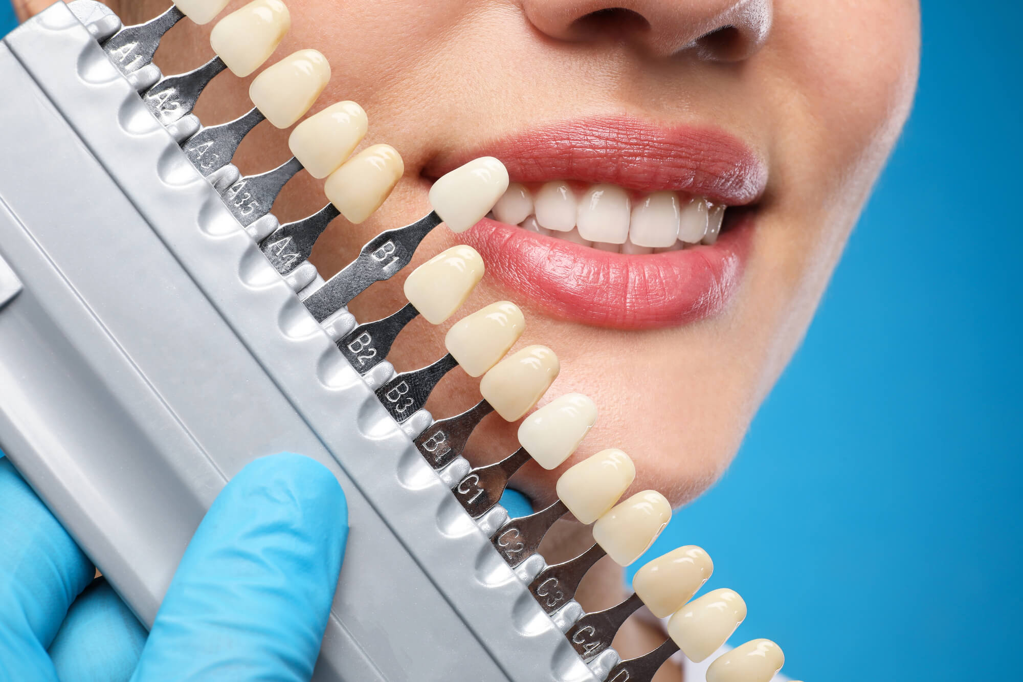 Same-Day Veneers and How CEREC Restorations Work