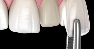 Same-Day Veneers and How CEREC Restorations Work